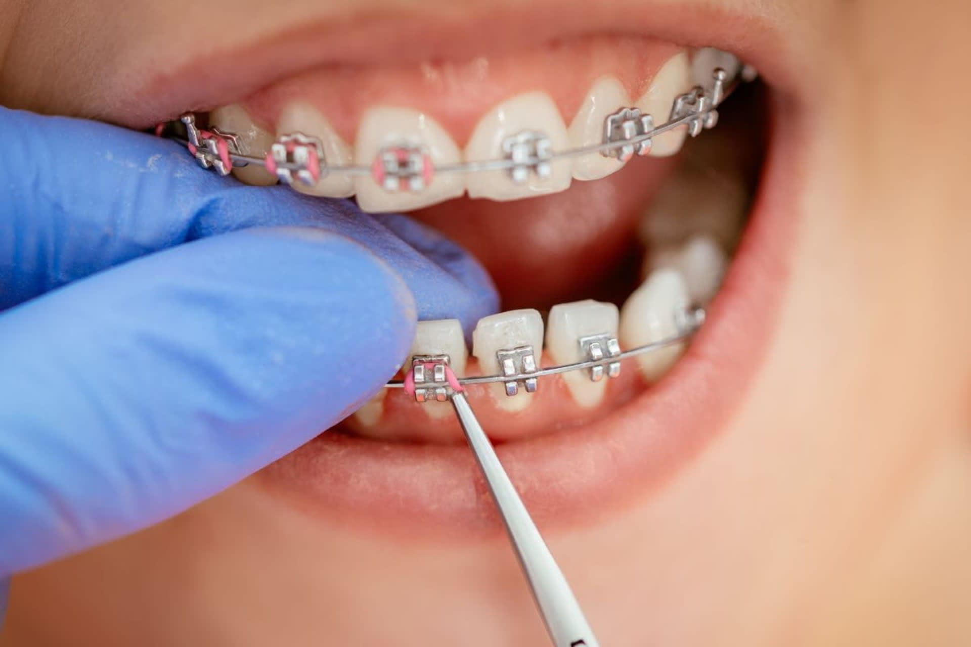 Braces Treatemnt Images (1) Treatment in Dhaka - Smile Dental Care
