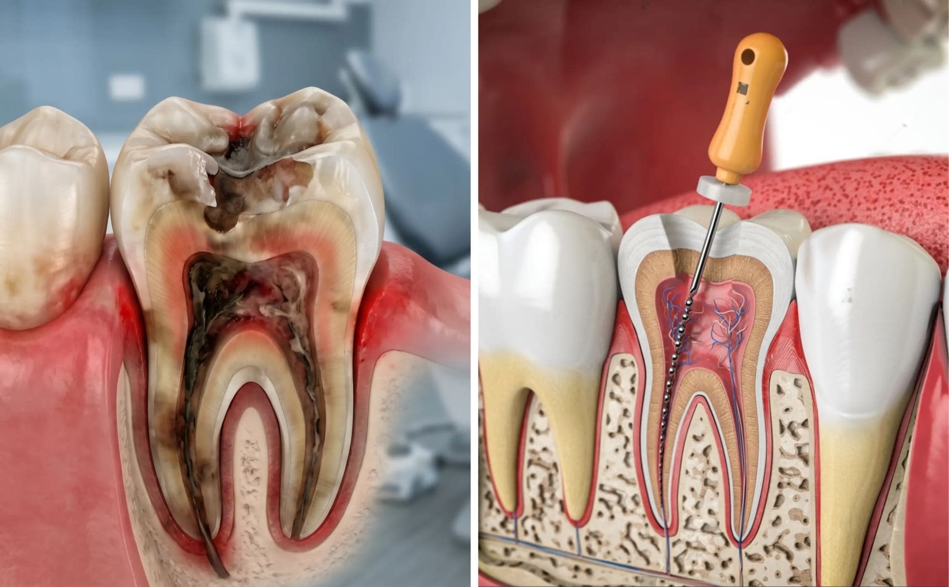 Smile Dental Care-এ অত্যাধুনিক মেশিনে রুট ক্যানেল ট্রিটমেন্ট সেবা