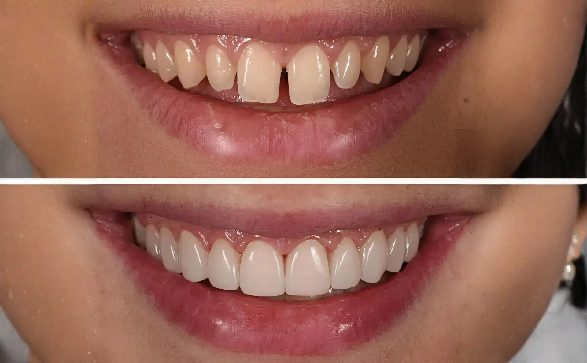 Composite Veneer Smile Dental Care Dhaka Treatment in Dhaka - Smile Dental Care