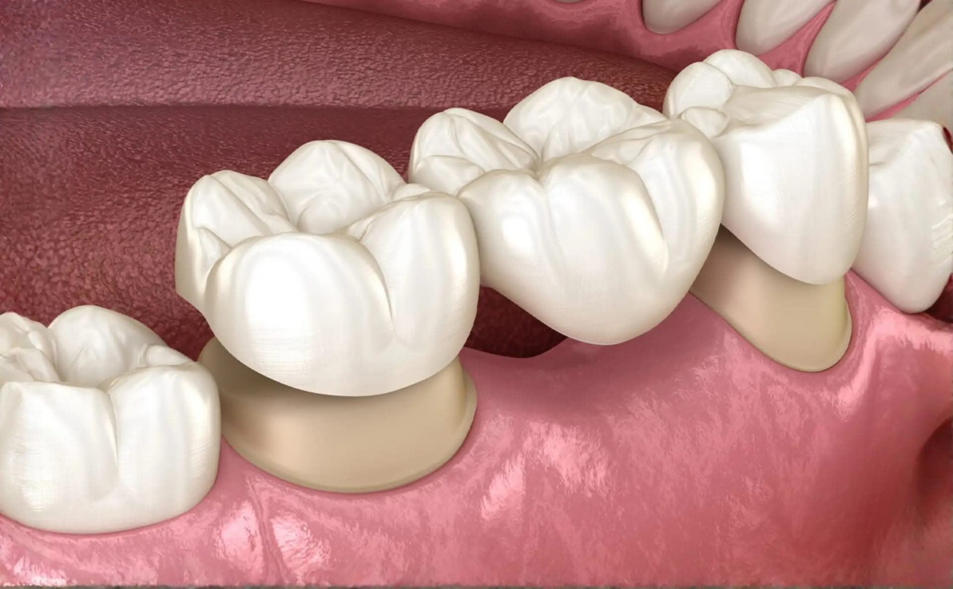 Dental Bridge For Missing Teeth Treatment in Dhaka - Smile Dental Care