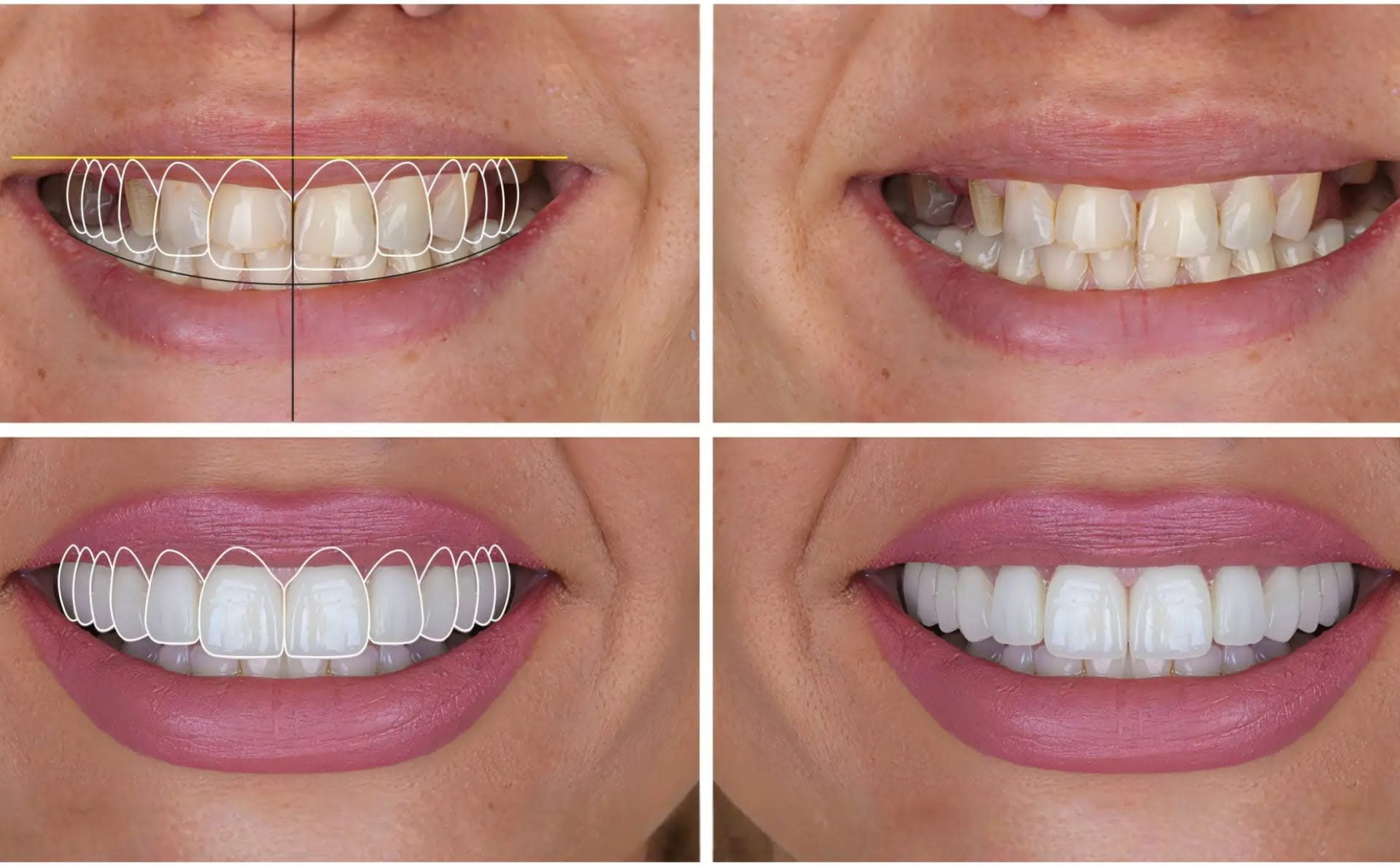 Digital Smile Design - Patient Success Story | Smile Dental Care