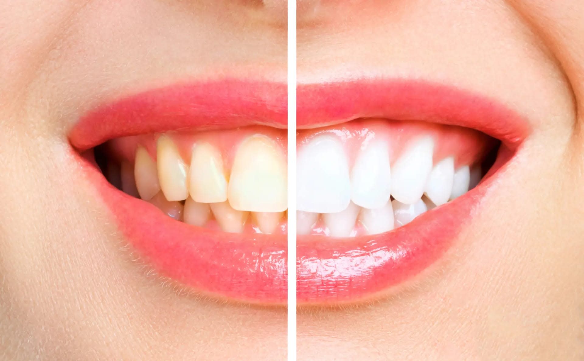 Professional Teeth Whitening Treatment in Dhaka - Smile Dental Care