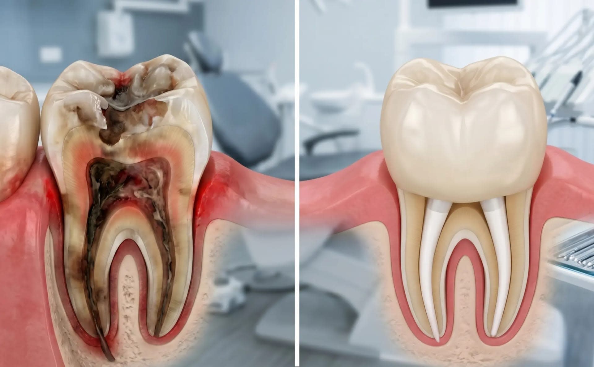 Dentist In Jatrabari Root Canal Treatment in Dhaka - Smile Dental Care