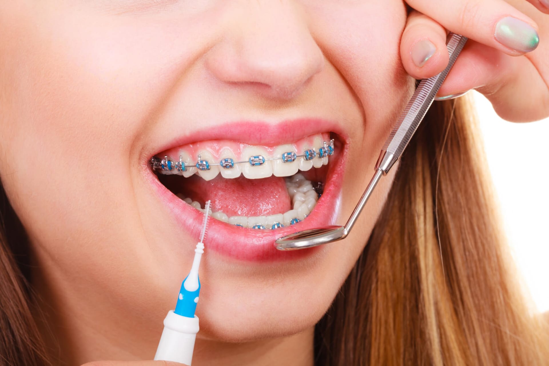 Braces Treatment Treatment in Dhaka - Smile Dental Care