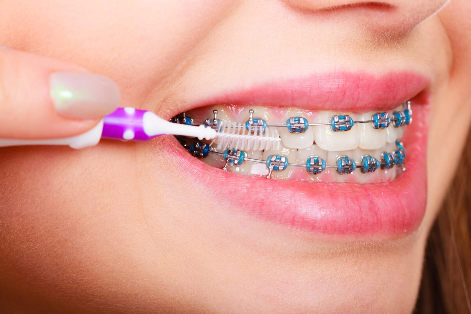 Braces Treatemnt Picture (1) Treatment in Dhaka - Smile Dental Care