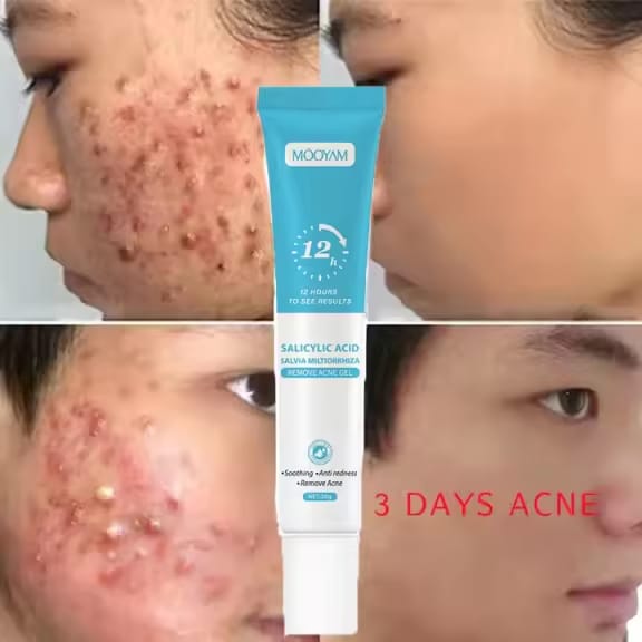MOOYAM Salicylic Acid Acne Cream