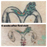 Premium Tattoo Removal & Skin Rejuvenation Laser