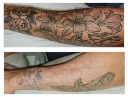 Premium Tattoo Removal & Skin Rejuvenation Laser