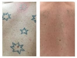 Premium Tattoo Removal & Skin Rejuvenation Laser