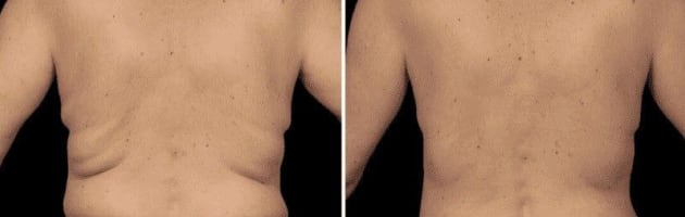 Cryotherapy Cool Sculpting - Fat Freezing Niche - Mobile Business run anywhere!