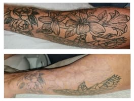 Premium Tattoo Removal & Skin Rejuvenation Clinic in Lane Cove, NSW