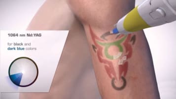 Premium Tattoo Removal & Skin Rejuvenation Laser