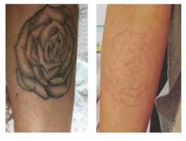 Premium Tattoo Removal & Skin Rejuvenation Clinic in Lane Cove, NSW