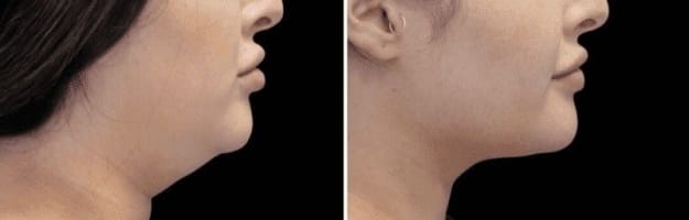 Cryotherapy Cool Sculpting - Fat Freezing Niche - Mobile Business run anywhere!