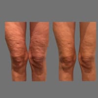 Cryotherapy Cool Sculpting - Fat Freezing Niche - Mobile Business run anywhere!