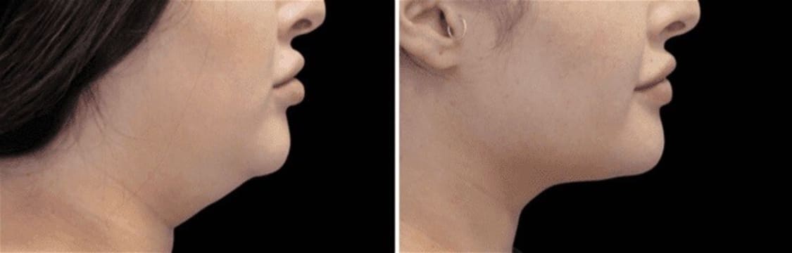 Cryotherapy Cool Sculpting - Fat Freezing Niche - Mobile Business run anywhere!