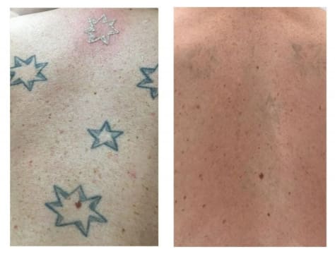 Premium Tattoo Removal & Skin Rejuvenation Laser