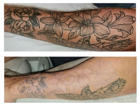 Premium Tattoo Removal & Skin Rejuvenation Laser