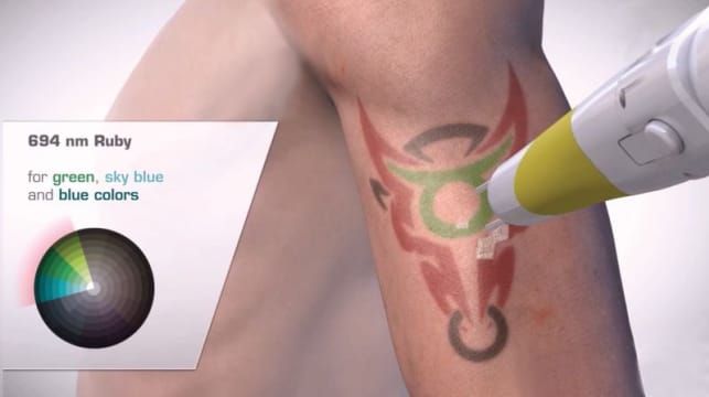 Premium Tattoo Removal & Skin Rejuvenation Laser