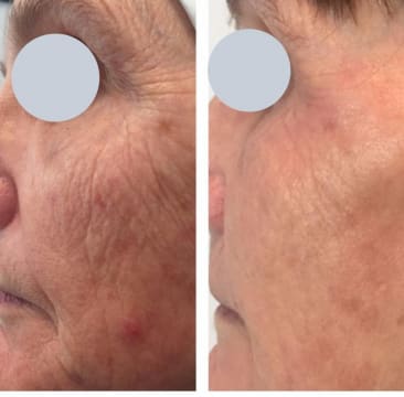 Premium Tattoo Removal & Skin Rejuvenation Laser