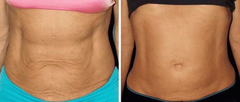 Cryotherapy Cool Sculpting - Fat Freezing Niche - Mobile Business run anywhere!