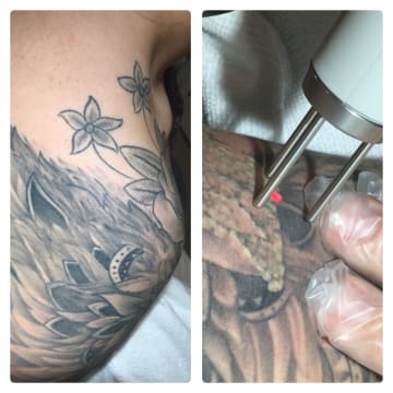 Premium Tattoo Removal & Skin Rejuvenation Laser