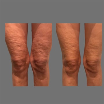 Cryotherapy Cool Sculpting - Fat Freezing Niche - Mobile Business run anywhere!