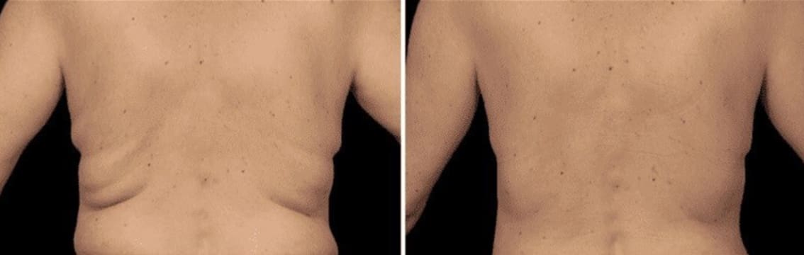 Cryotherapy Cool Sculpting - Fat Freezing Niche - Mobile Business run anywhere!