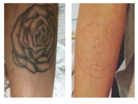 Premium Tattoo Removal & Skin Rejuvenation Laser