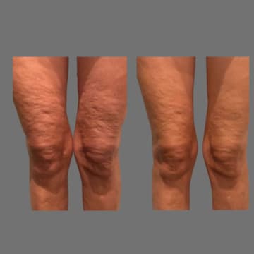 Cryotherapy Cool Sculpting - Fat Freezing Niche - Mobile Business run anywhere!