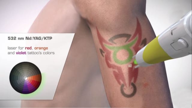 Premium Tattoo Removal & Skin Rejuvenation Laser