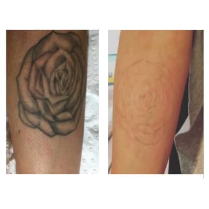 Premium Tattoo Removal & Skin Rejuvenation Clinic in Lane Cove, NSW