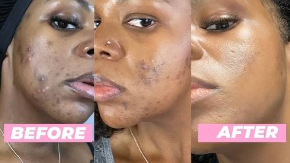 Anti-Acne Facial