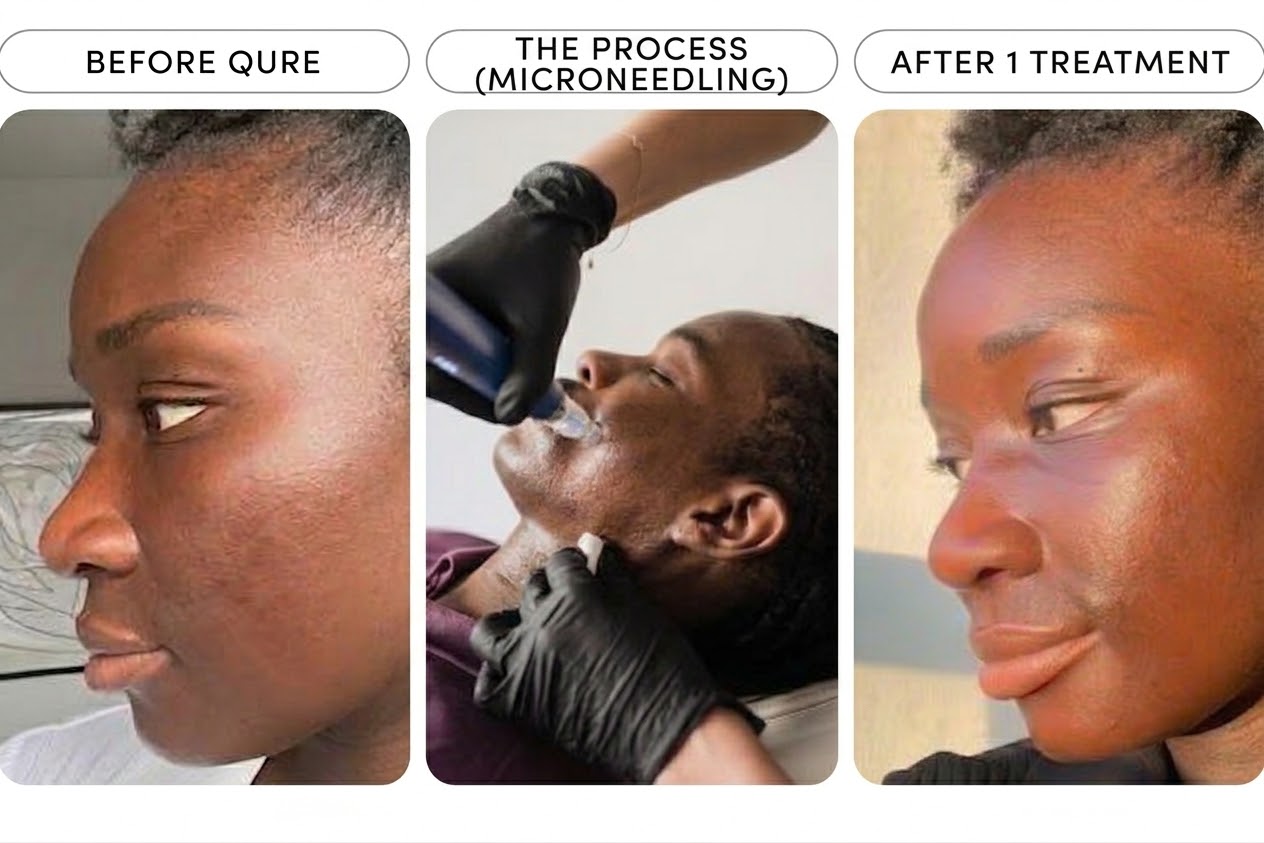 Micro Needling