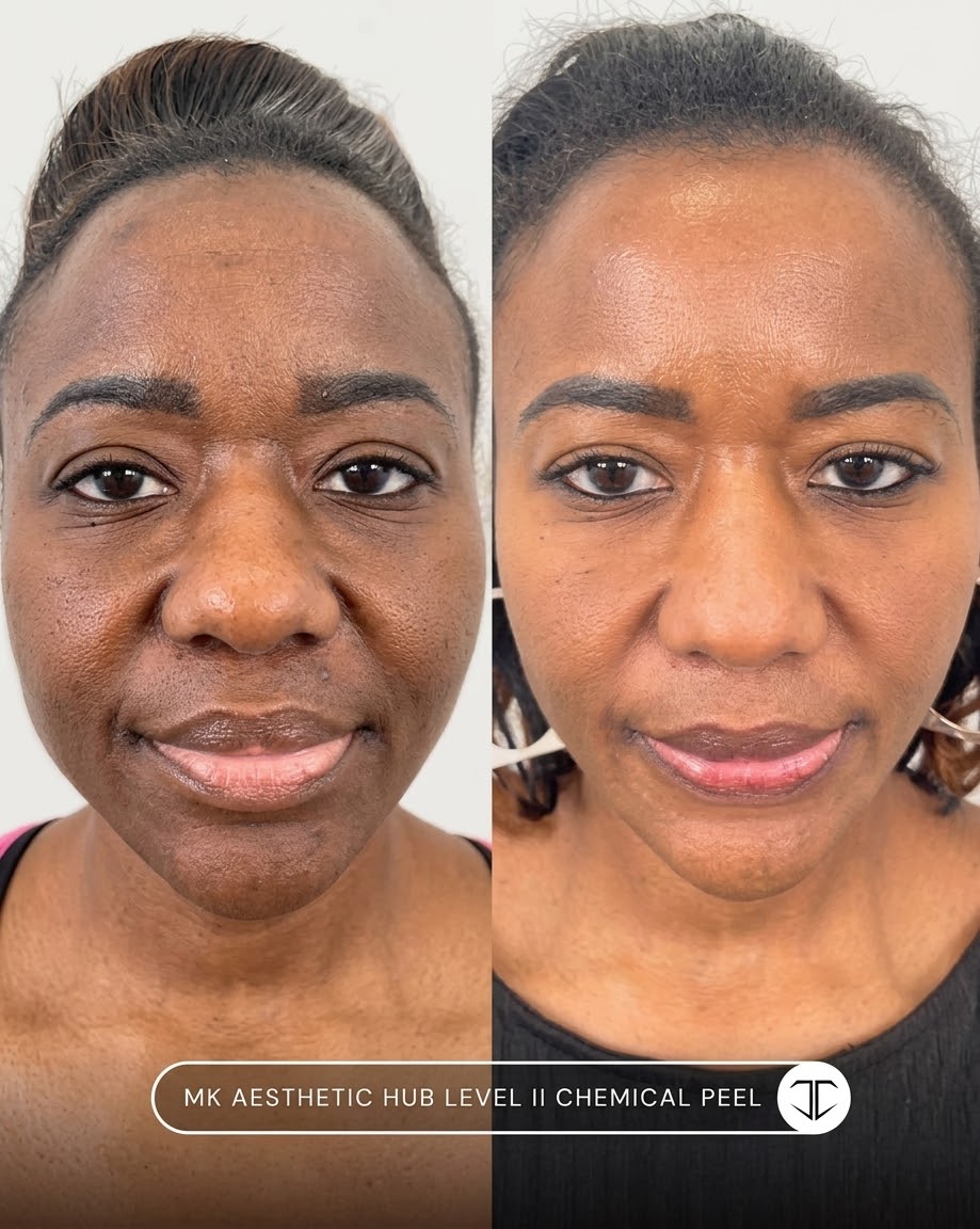 Chemical Peel