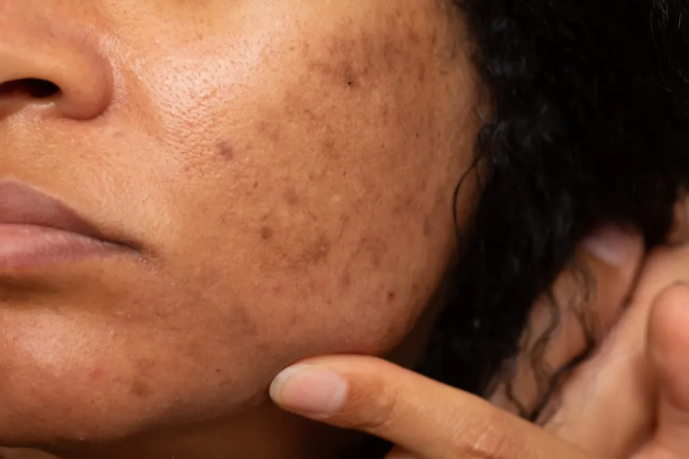 Clear Skin Journey: How to Remove Black Marks on Face Naturally 2026
