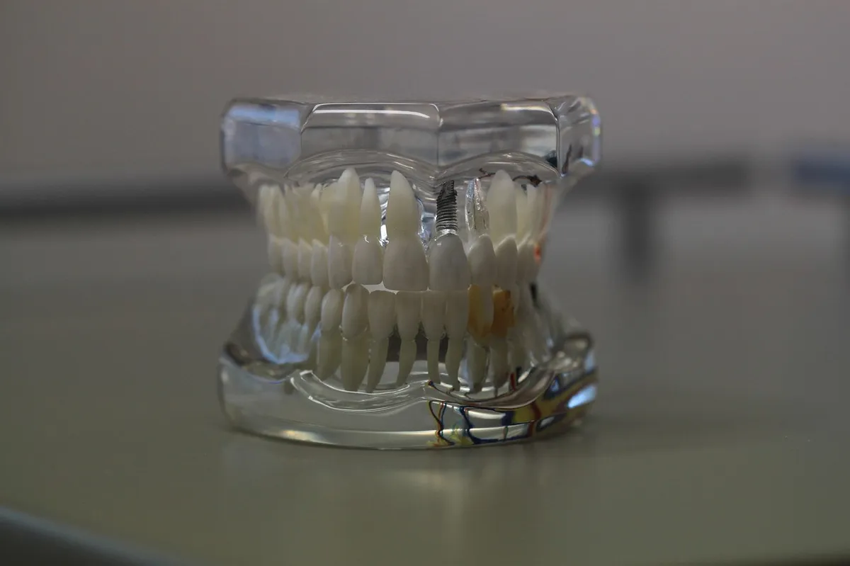 ¿Cómo saber si necesito un implante dental? La guía definitiva