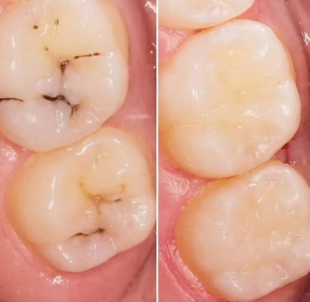 Todo lo que debes saber sobre las calzas dentales