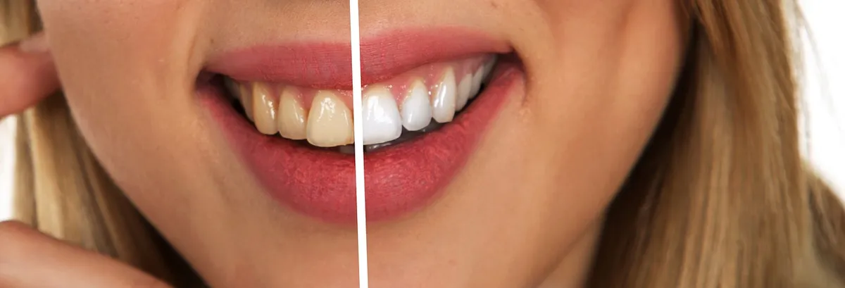 ¿Miedo o sensibilidad? La verdad sobre la limpieza dental profesional que nadie te explica