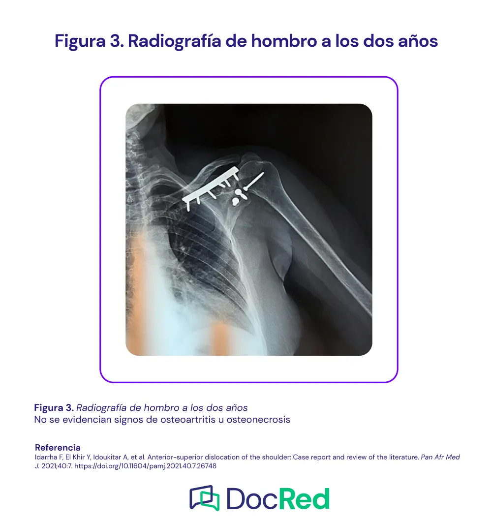 Caso Cl nico Fractura luxaci n Cr nica Del Hombro Docred caso-cl-nico-fractura-luxaci-n-cr-nica-del-hombro-docred