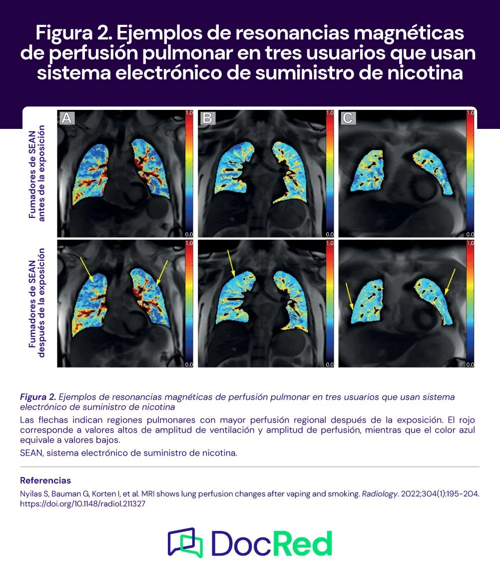 Pulmones al descubierto: resonancia magnética revela riesgos de vapear y  fumar