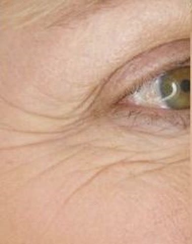 Crows feet wrinkles around the eyes