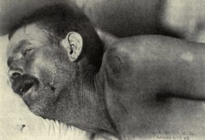 Meningitis symptom