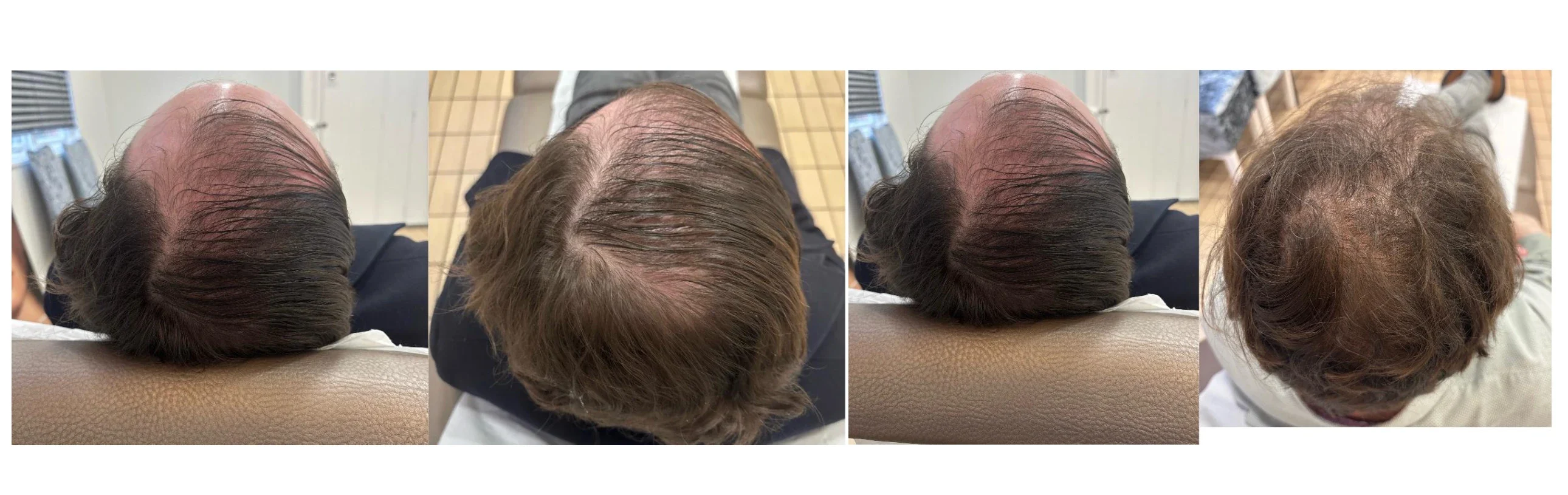 Hair Treatment at YA Skin and Hair Clinic: