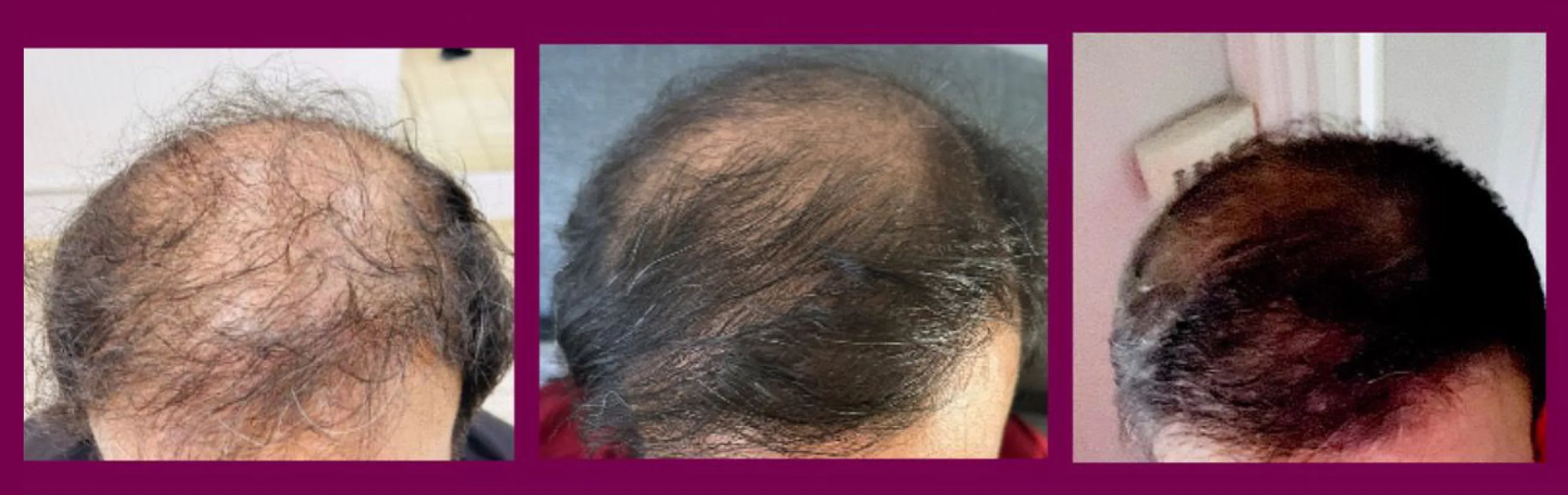 PRP hair treatment – a natural solution for hair loss