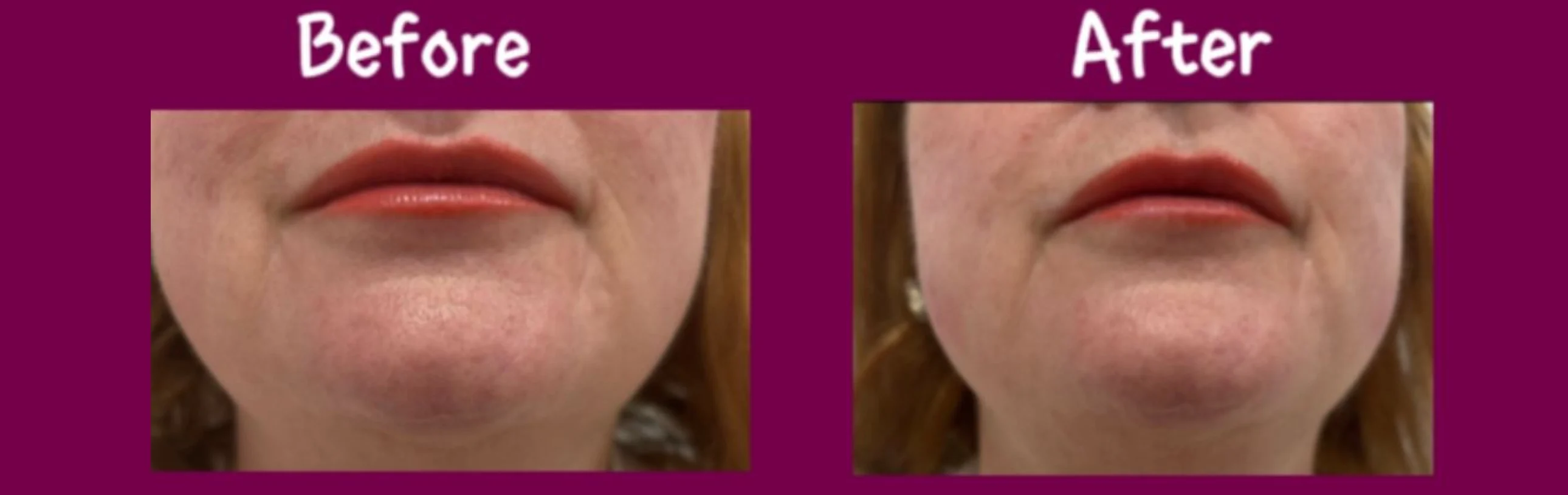 Chin lift treatment for a naturally sculpted jawline