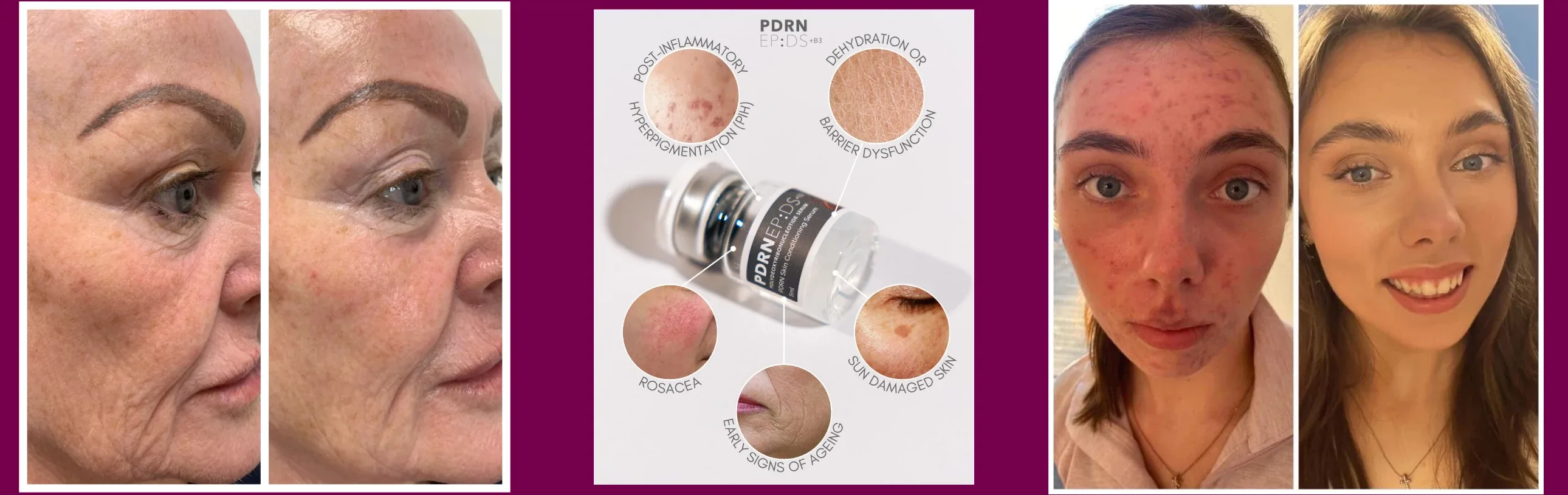 Repair, Restore & Rejuvenate with PDRN Skin Therapy in Nottingham