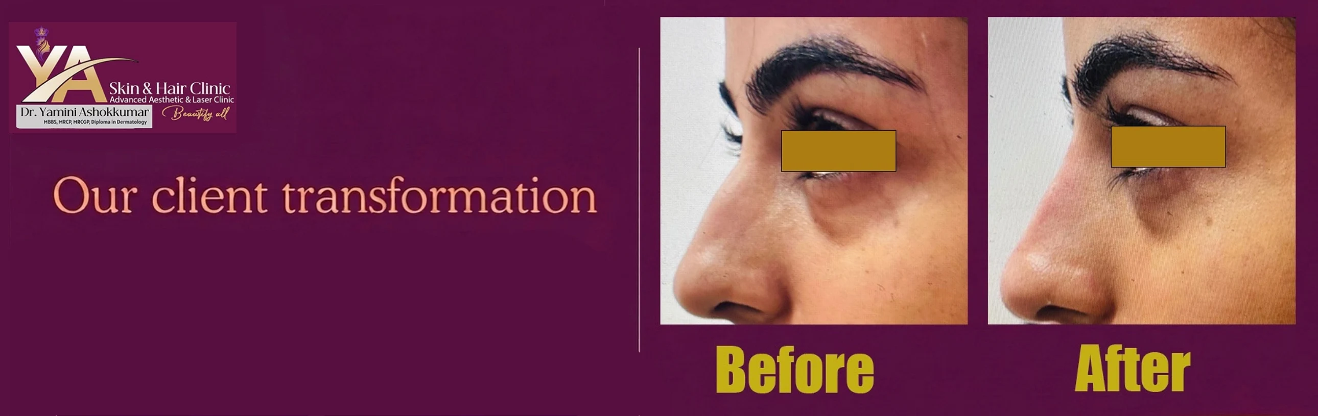 Non-Surgical Rhinoplasty in Nottingham – A Safe, Doctor-Led Nose Enhancement