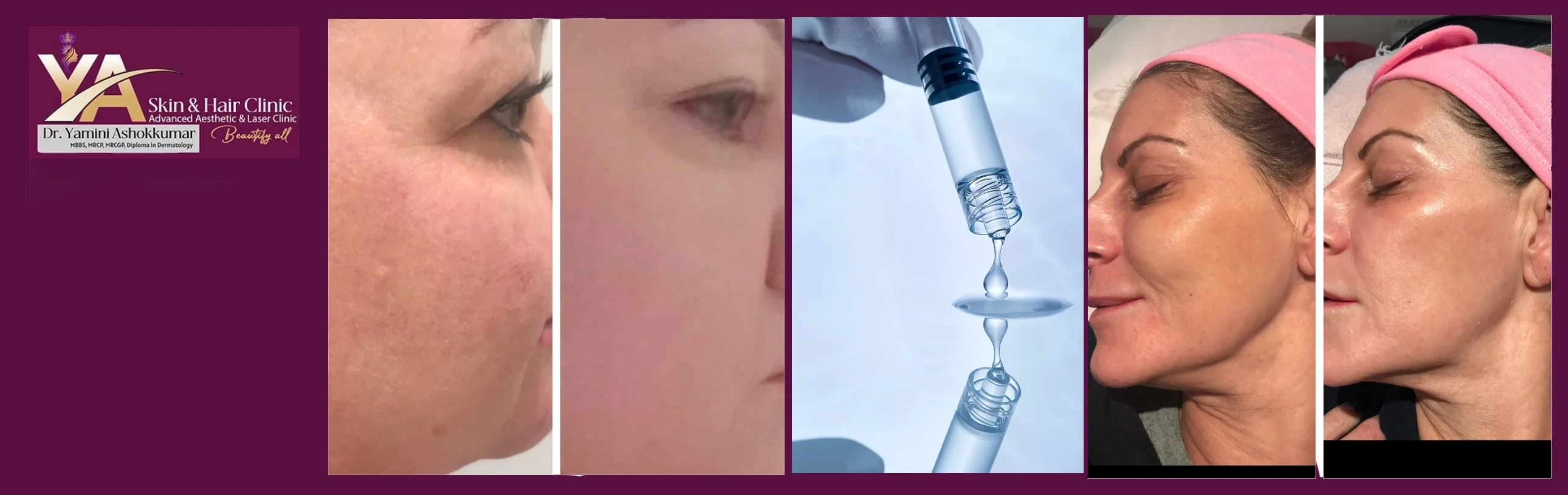 Baby Glow Treatment at YA Skin and Hair Clinic: Get Radiant, Glass-Like Skin