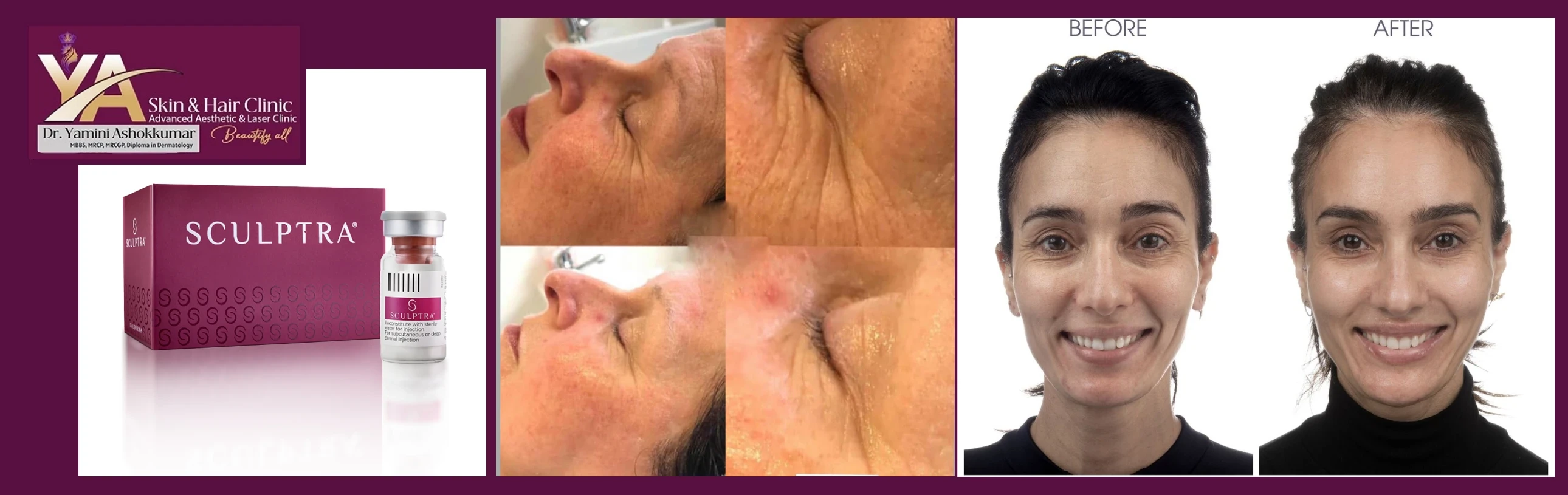 Sculptra Treatment at YA Skin and Hair Clinic: Restore Volume, Tighten Skin & Rejuvenate Naturally